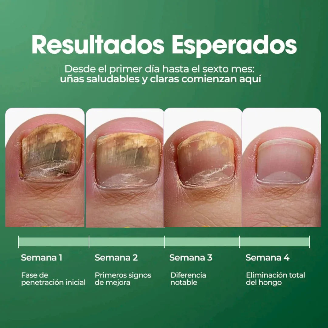 TERBINAFINA : El aceite que elimina los hongos de tus uñas