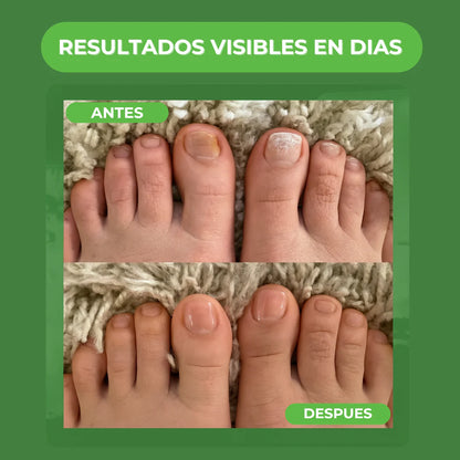 TERBINAFINA : El aceite que elimina los hongos de tus uñas